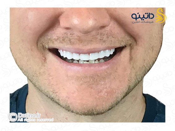 عکس روکش دندان سفید ردیف بالا 14564 - انواع مدل روکش دندان سفید ردیف بالا 14564